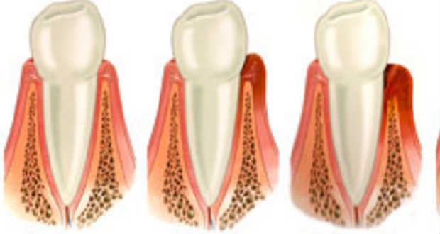 Ínyvérzés, ínygyulladás: otthon is kezelhető