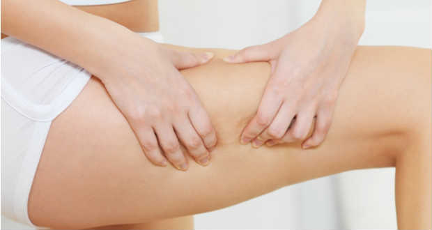 Narancsbőr: mitől alakulhat ki?