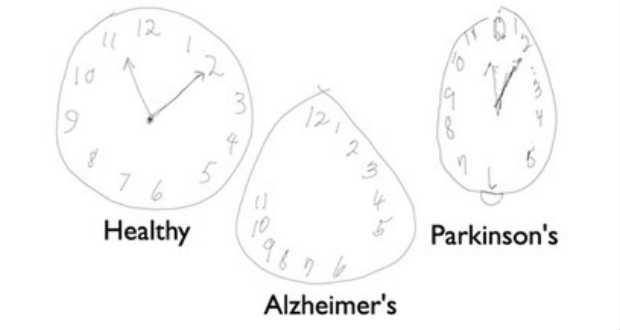 Új módszer a Parkinson- vagy az Alzheimer-kór kiderítésére