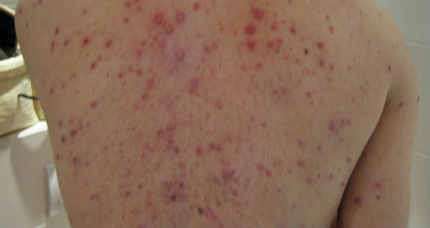 Tovább terjed a kanyaró Kárpátalján