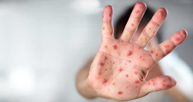 Ismét növekszik a kanyarós megbetegedések száma Kárpátalján