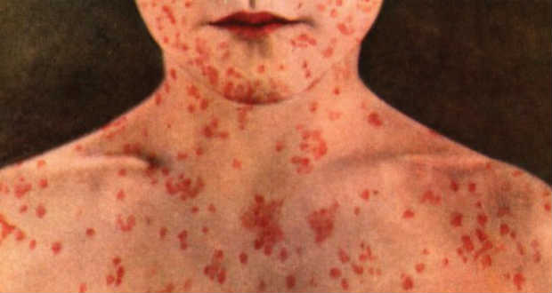 Egyre több a kanyarós megbetegedések száma Romániában