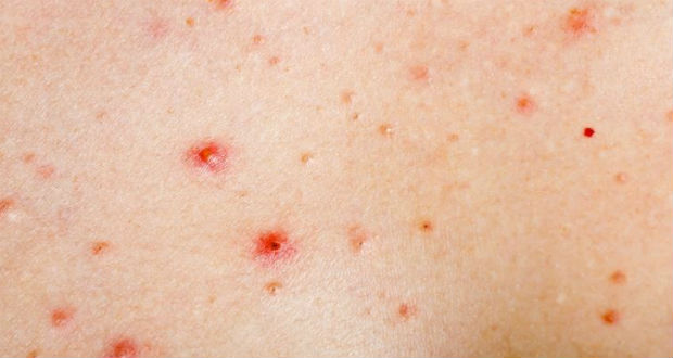 Vörös foltok a testen megduzzadnak és viszketnek Allergiás kiütések