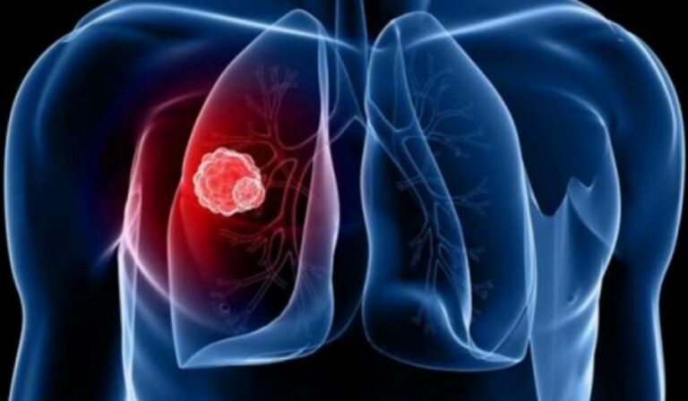 Közel 1000 új tuberkulózisos személyt regisztráltak decemberben