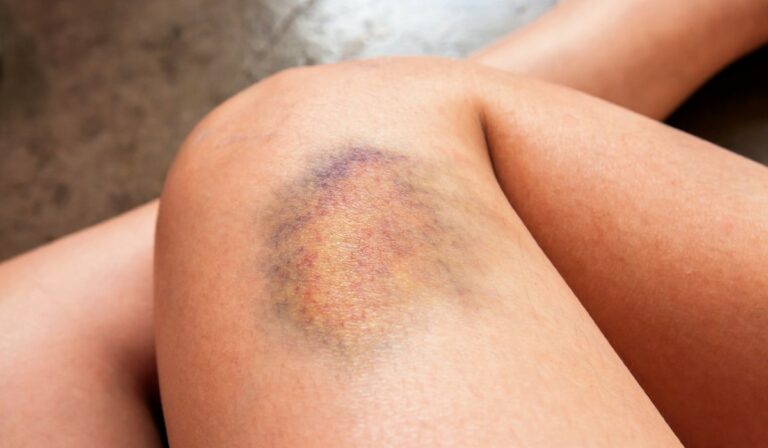 Hogyan keletkeznek a véraláfutások a bőrön?