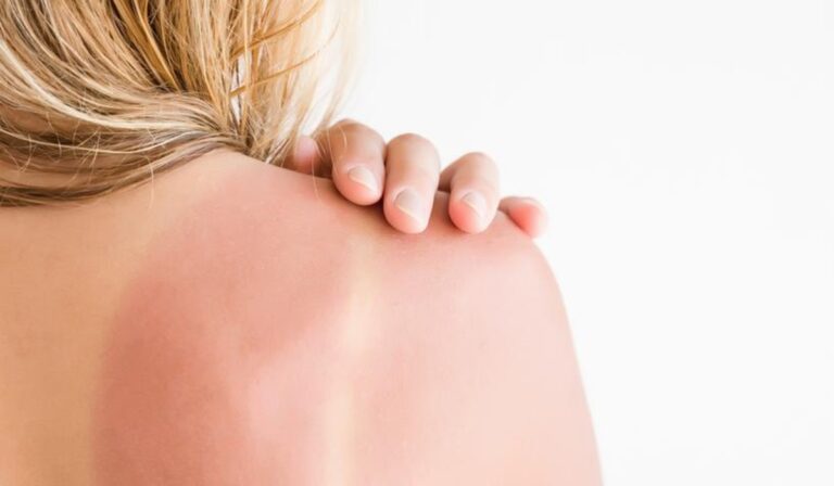 Napégés: ezeket ajánlja a bőrgyógyász