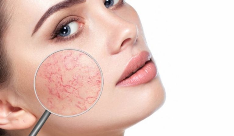Rosacea: így kerülhető el a kipirosodott bőr