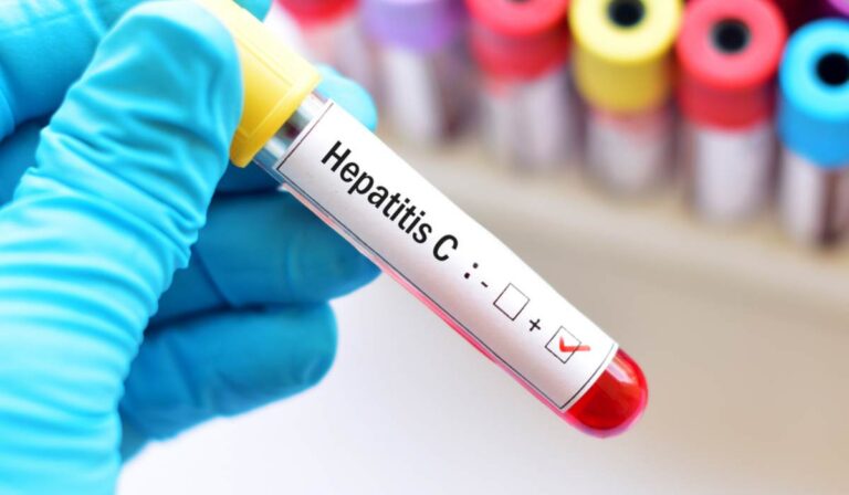 Hepatitis C: Ukrajnában a fertőzöttek csupán 7%-a tud betegségéről