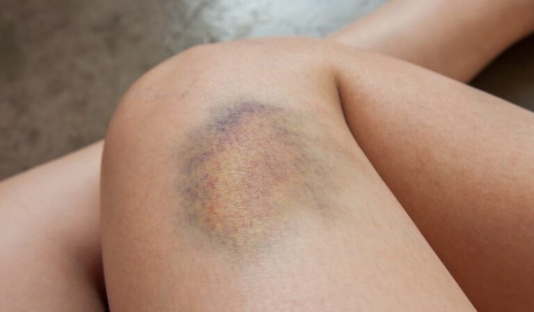 Betegséget jelezhetnek a kék-zöld foltok a bőrön