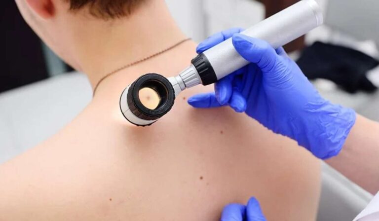 Május 18-án rendezik meg Ukrajnában a melanoma diagnosztikai napját