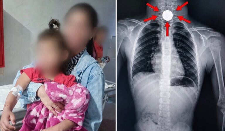 Meglepően hasonló esetek: pénzérmét nyelt két kiskorú Kárpátalján